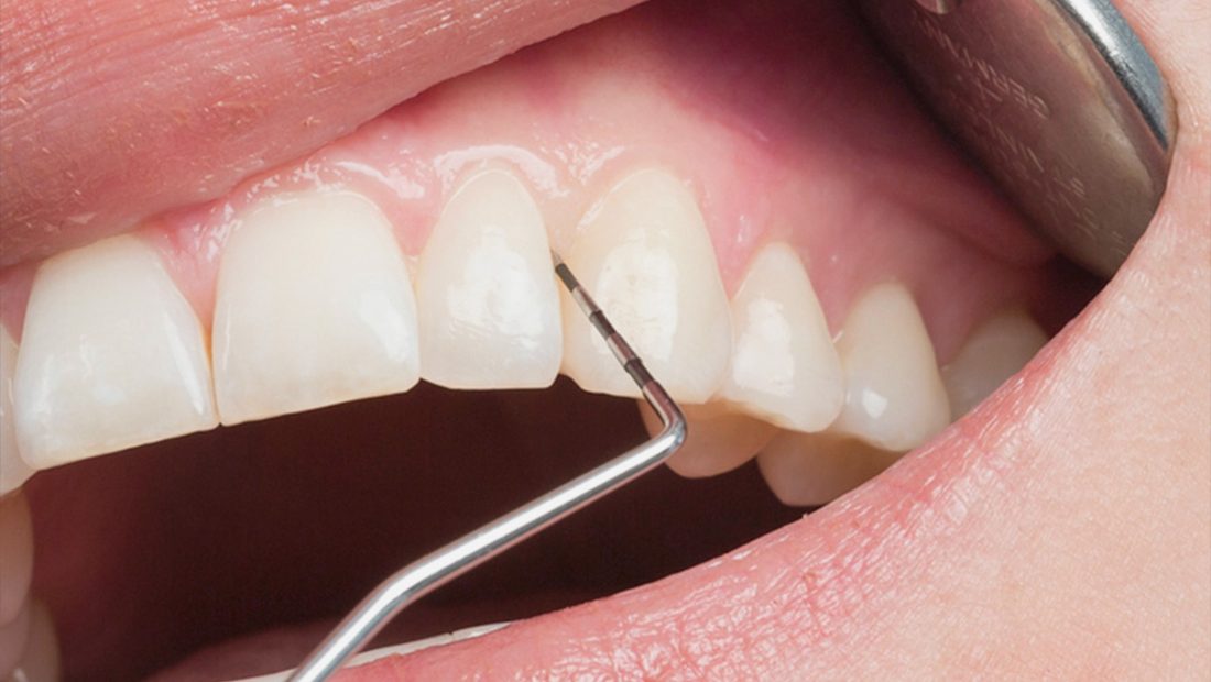 Controllo di denti e gengive con sonda parodontale